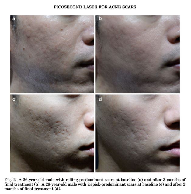 Hieu-qua-dieu-tri-seo-mun-bang-laser-picosecond