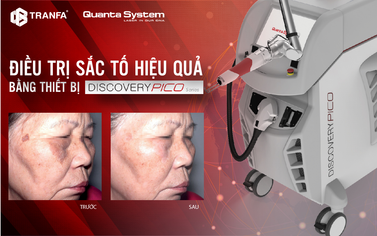 điều trị sắc tố bằng discovery pico