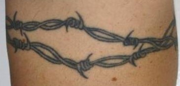 Xóa xăm vĩnh viễn bằng laser q-switch