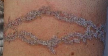 Xóa xăm vĩnh viễn bằng laser q-switch