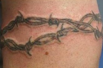 Xóa xăm vĩnh viễn bằng laser q-switch