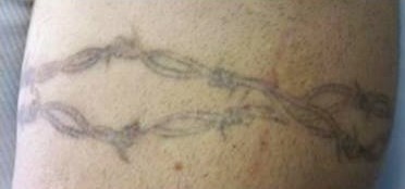 Xóa xăm vĩnh viễn bằng laser q-switch