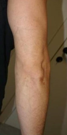 Xóa xăm vĩnh viễn bằng laser q-switch