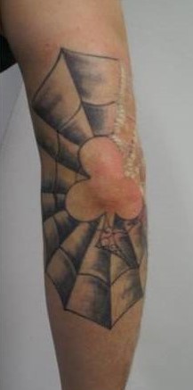 Xóa xăm vĩnh viễn bằng laser q-switch