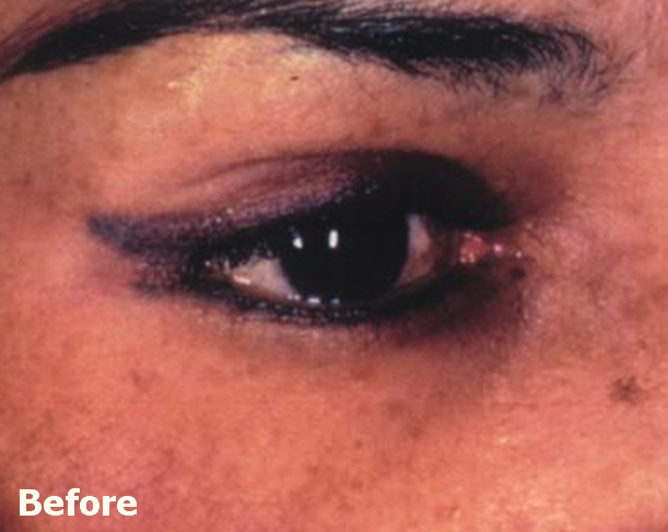 Xóa xăm vĩnh viễn bằng laser q-switch