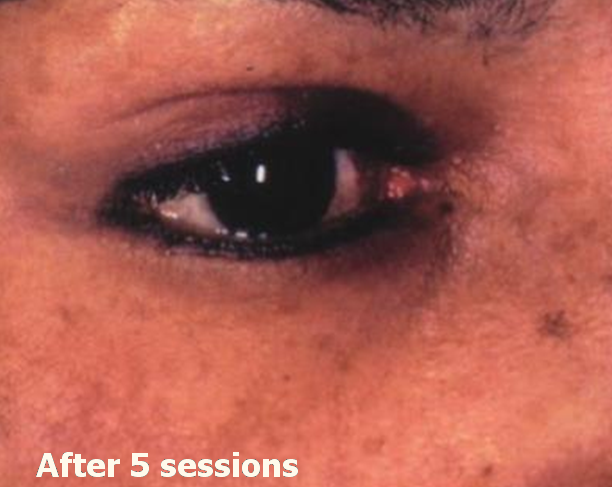 Xóa xăm vĩnh viễn bằng laser q-switch