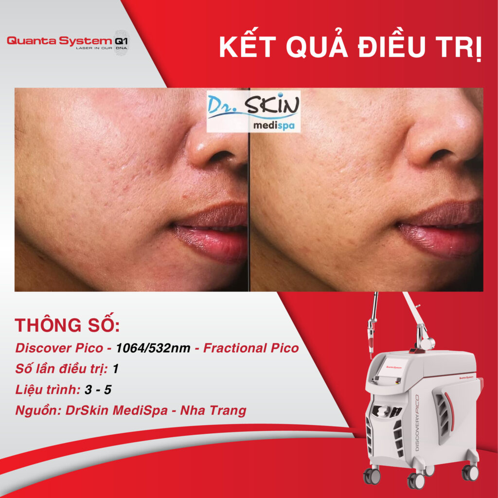 ket-qua-dieu-tri-tu-discovery-pico
