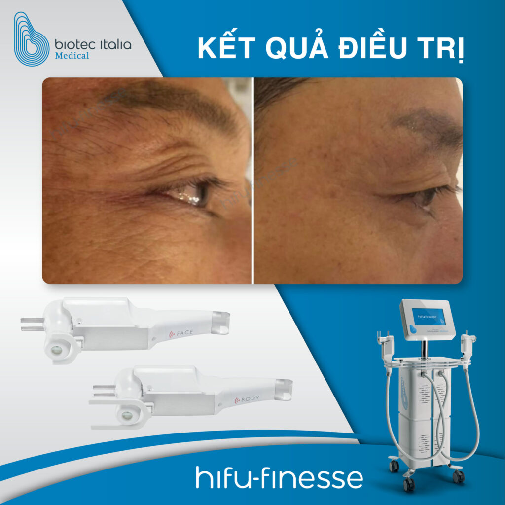 ket-qua-dieu-tri-bang-hifu-finesse-sau-60-ngay-1-lan-thuc-hien-1