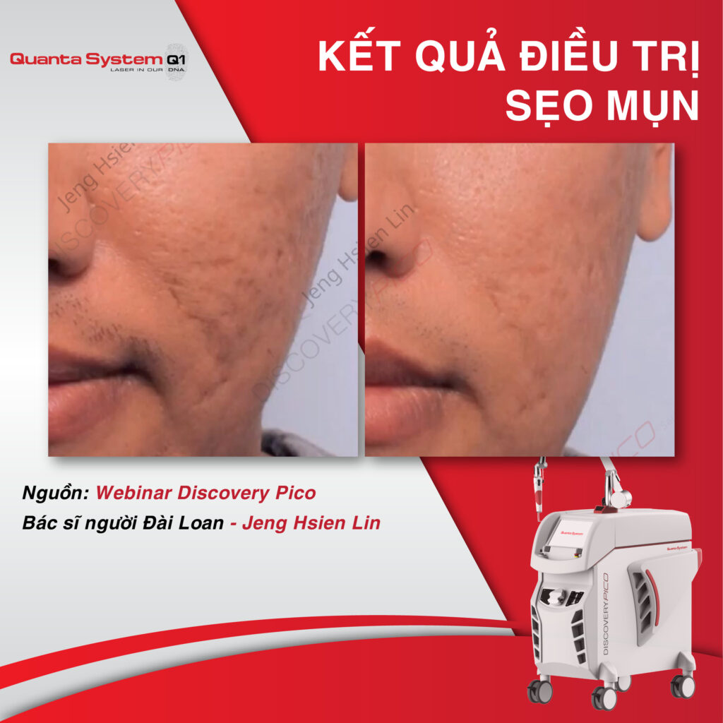ket-qua-dieu-tri-seo-mun-voi-laser-discovery-pico-quanta-system